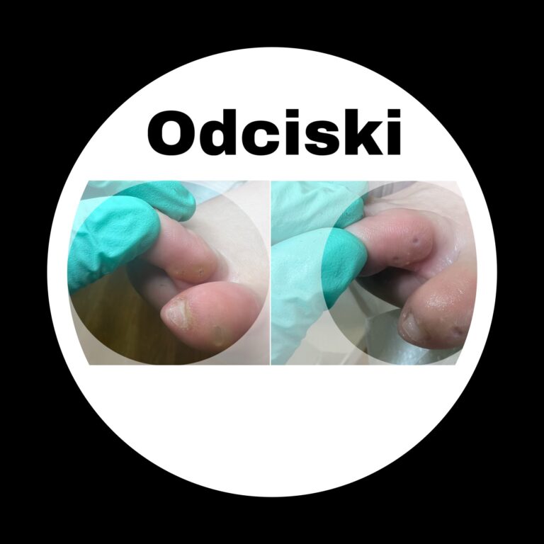 Odciski na palcach oraz odciski na śródstopiu
