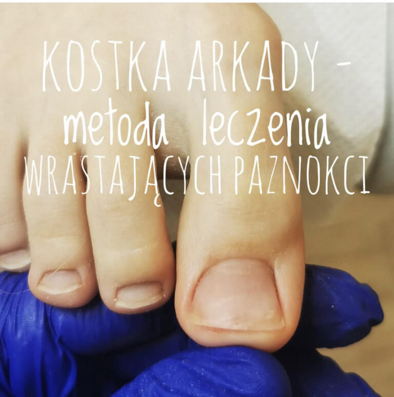 Wkręcający a wrastający paznokieć – jak odróżnić?